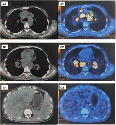 Multisystemic Sarcoidosis Presenting With Leg Ulcers, Pancytopenia, and Polyserositis Was Successfully Treated With Glucocorticoids: A Case Report and Literature Review